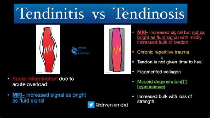 Is tendonitis the same as tendonitis