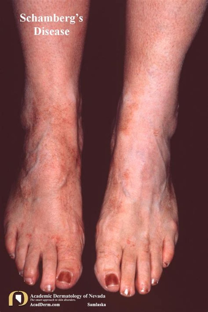 What is Schambergs purpura